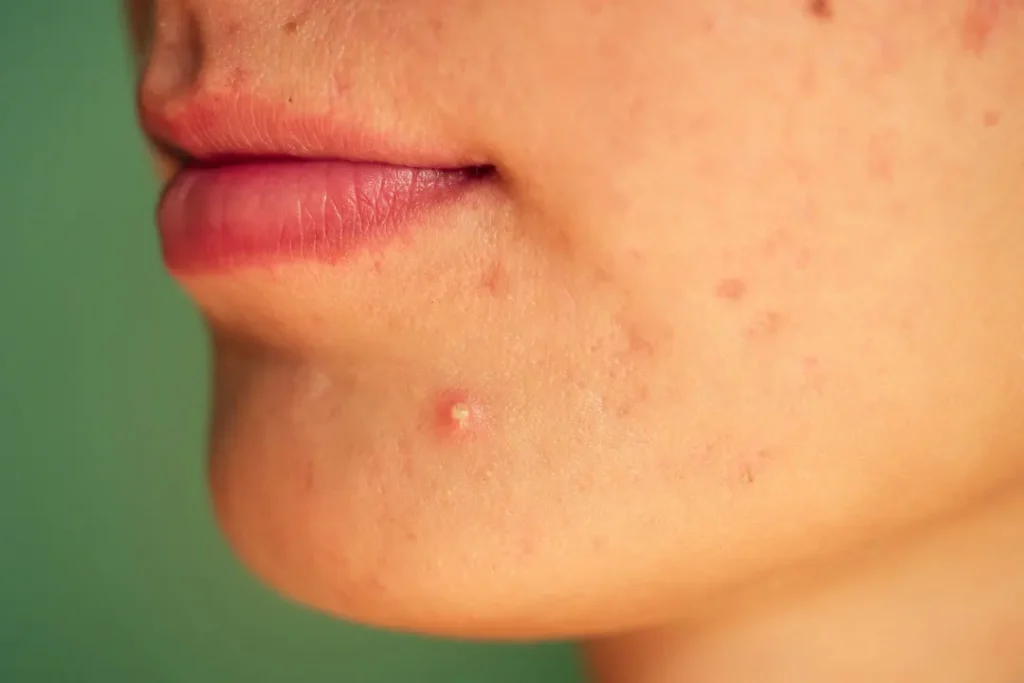 Acne problem. 